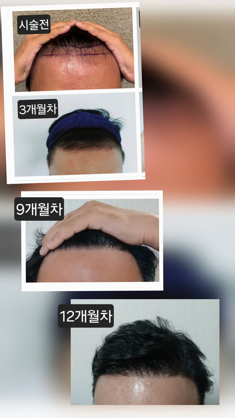 뉴헤어, 모발이식 3400모 12개월차 후기