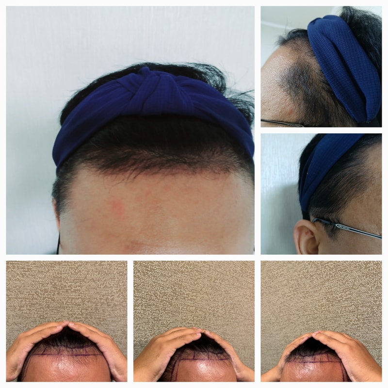 수술후 3개월 후기