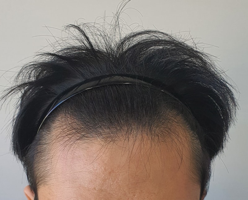 모재성 1200모낭 비절개 모발이식 후기
