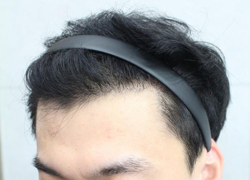 06.수술 9개월차(3).JPG