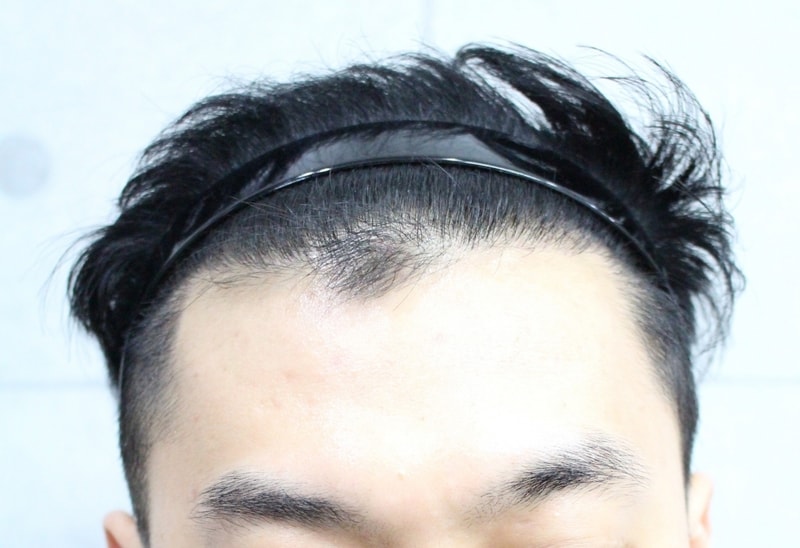 02.수술 5개월차(1).jpg