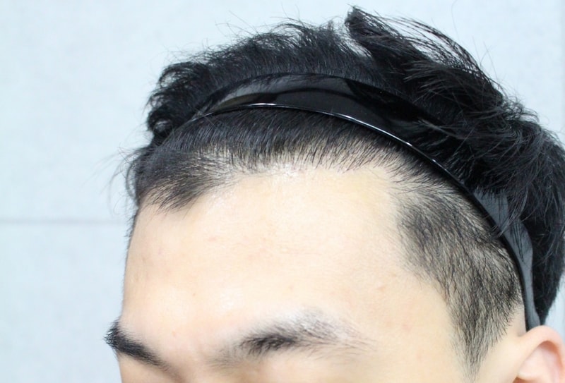 02.수술 5개월차(3).jpg