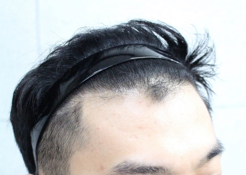 02.수술 5개월차(2).jpg