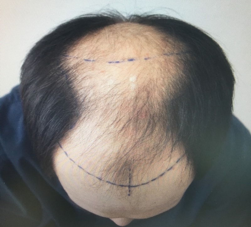 모발이식 수술후 13개월 경과사진올립니다