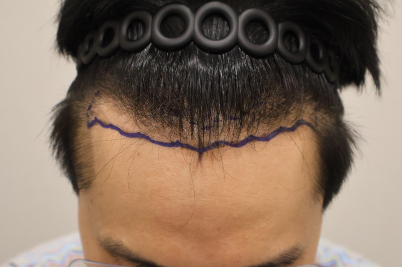 Dongtan Hairro Clinic Non-Cutting Hair Transplantation 2,400 Mo 2 weeks have passed