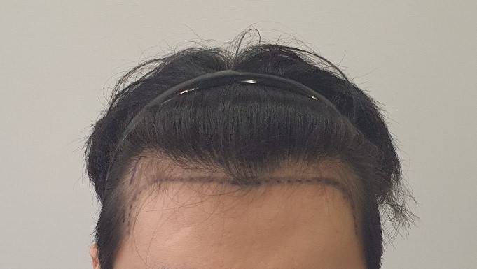 1200모낭 비절개 이식 후기