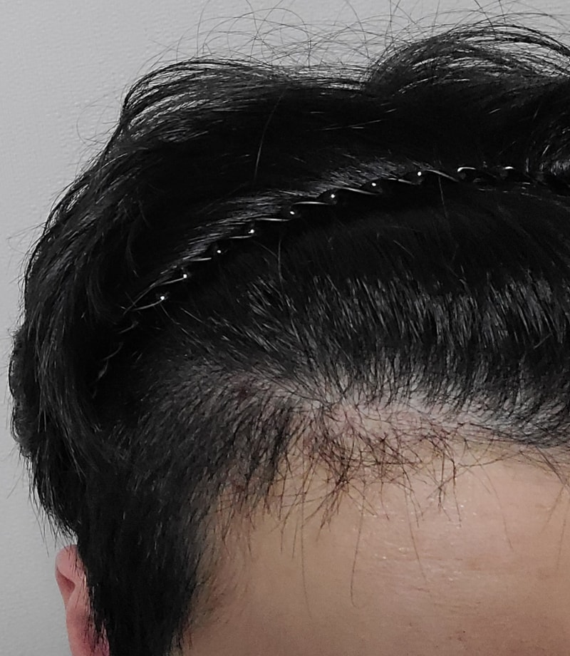 모재성 수술 한달반차 후기