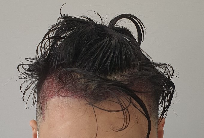 이식후당일.jpg