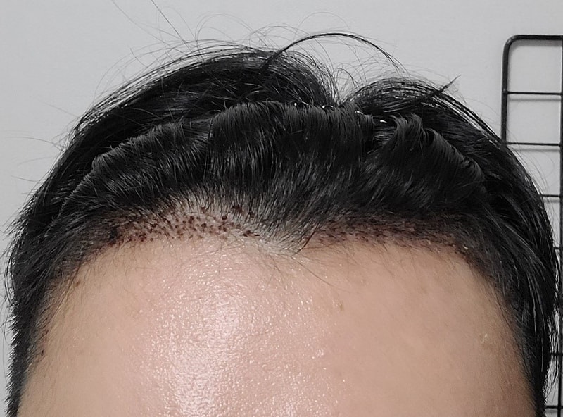 이식후현재.jpg