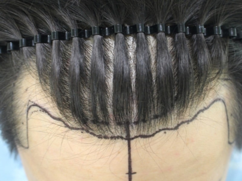 Hannaive M-shaped 2400 hair incision transplantation is 6 months late.