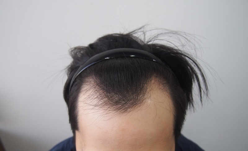Post a review in the 11th month of transplantation.
