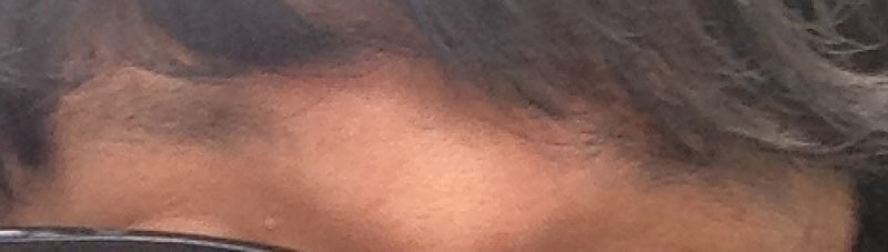 [JP모발이식]눈썹이식후기도 되나요?ㅎㅎ JP성형외과 눈썹이식후기