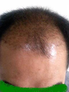 수술 후_2011.11m18.JPG