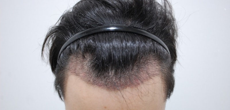 수술후 15일.jpg