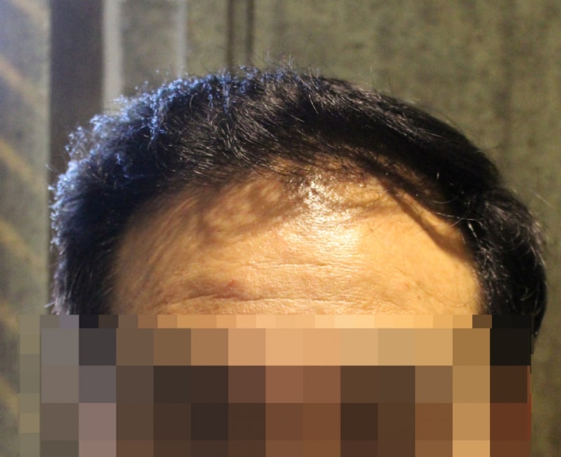 0수술후1년이후.png