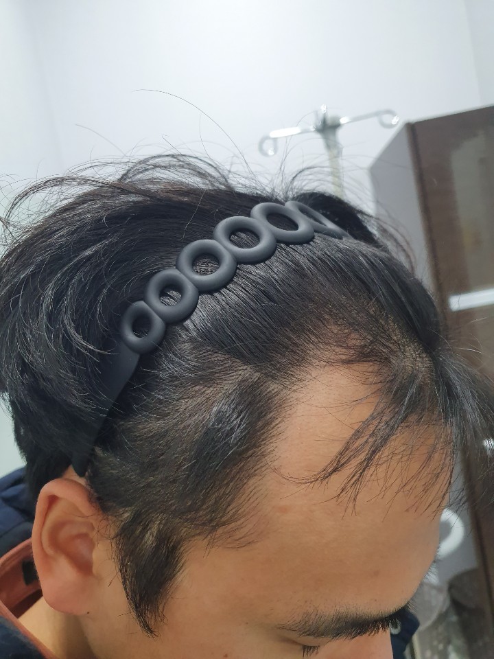 비절개 모발이식 2주차 입니다.