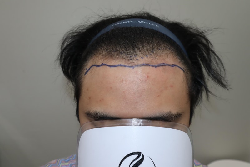 모발이식전1.jpg