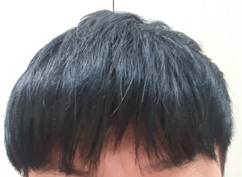 현재 로게인폼 바른후 5시간.jpg