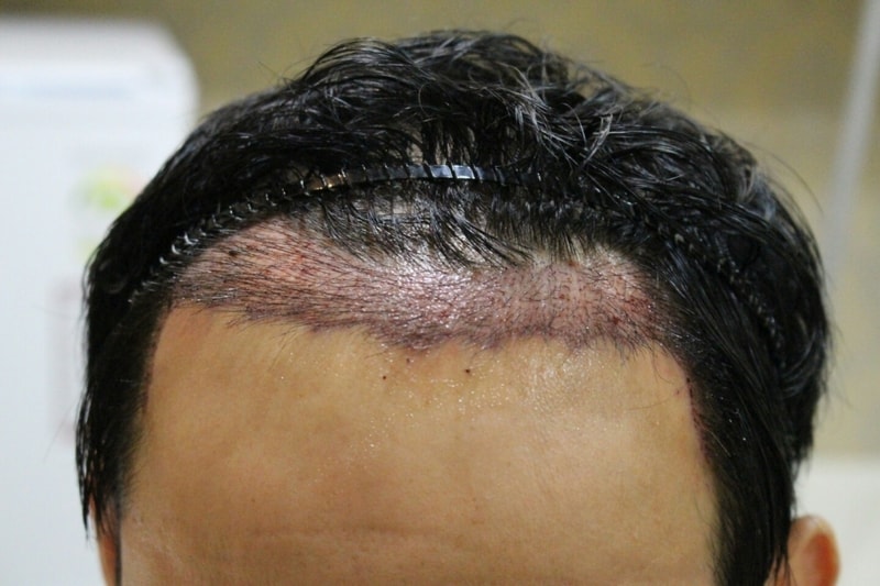 수술 후.jpg