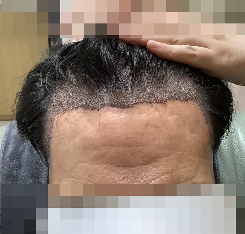 4 이마라인정면 샴푸.jpg