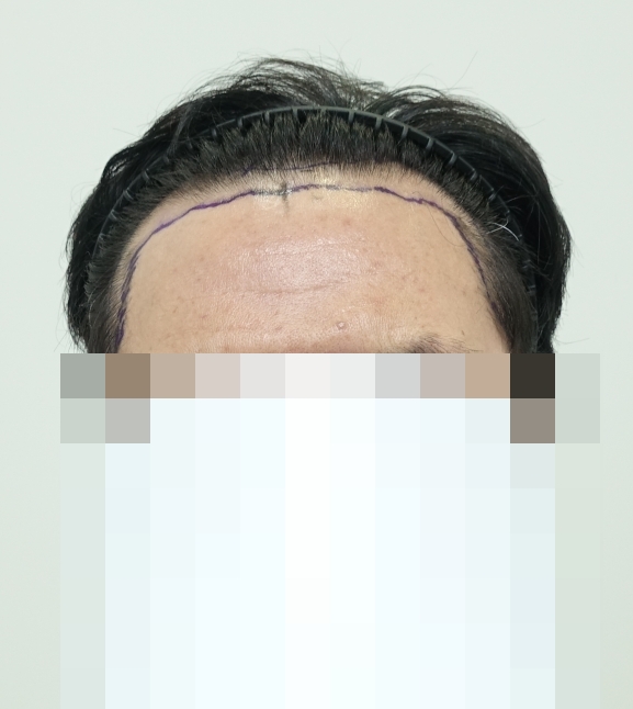 1 이마라인정면.jpg