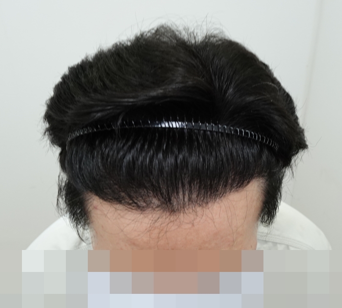 이마 위.jpg