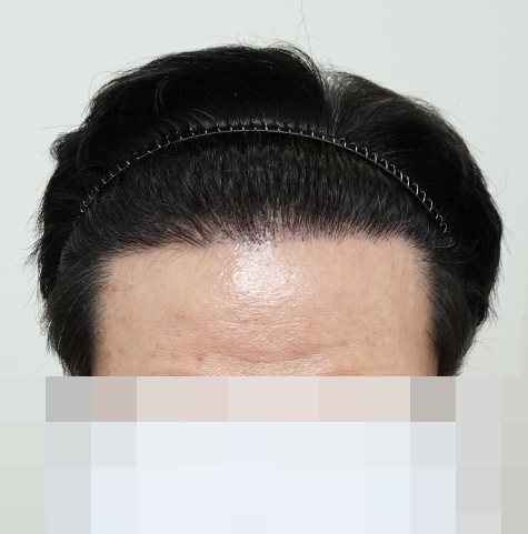 이마.jpg
