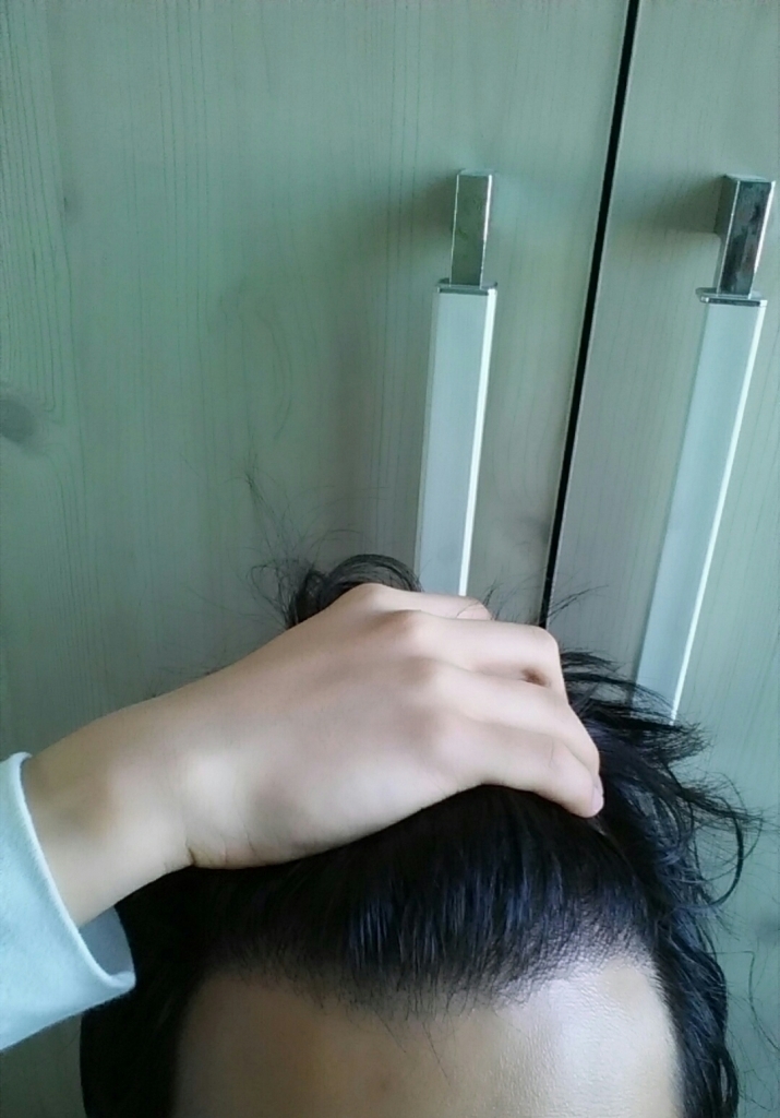 포헤어 M자 800모낭 이식 11달차 후기