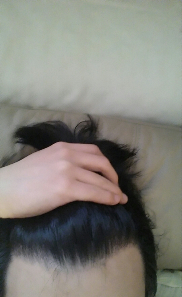 포헤어 M자 800모낭 이식 10달차 후기