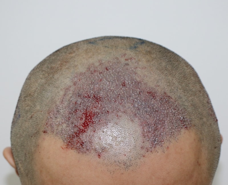 수술 직후.jpg