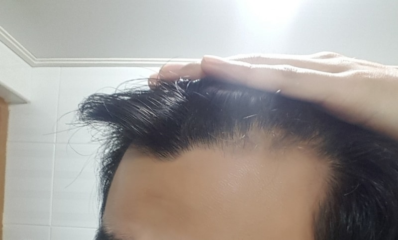 수술전_좌측1.jpg