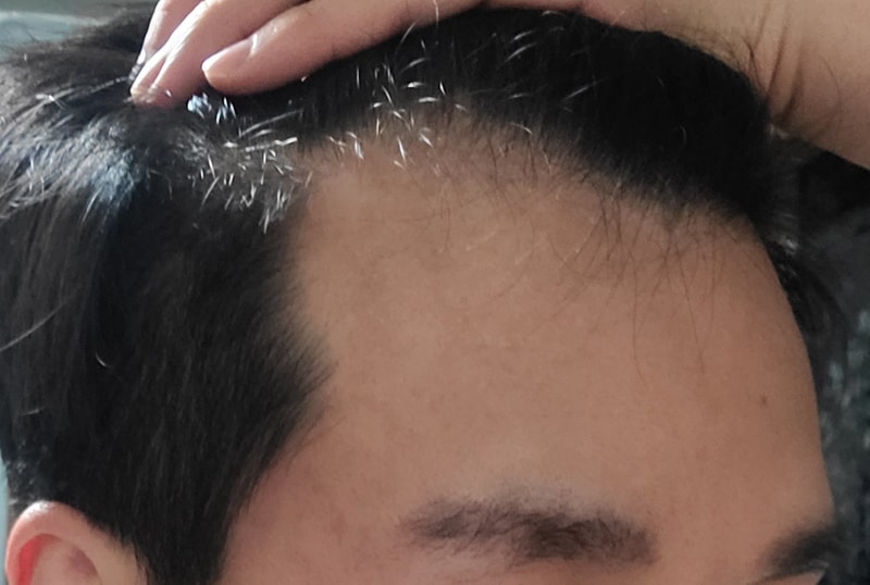 20대 남자 M자 구렛나루 비절개 모발이식 1일차 후기