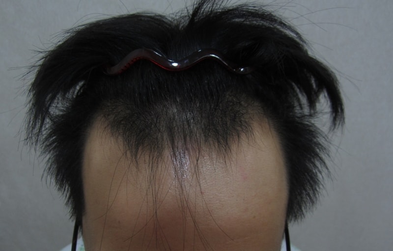 수술전 정면.jpg