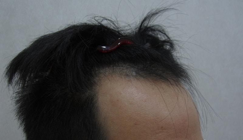 수술전 우측.jpg