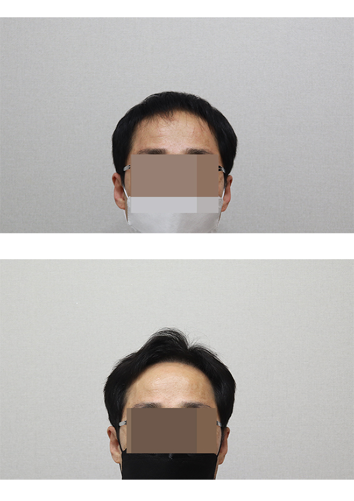 일반스타일전후.jpg