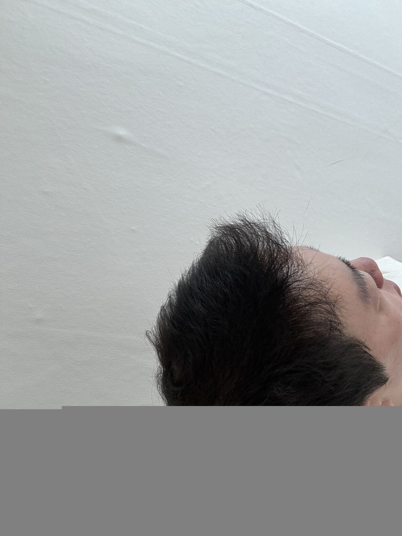 모재성 2000모낭 1년