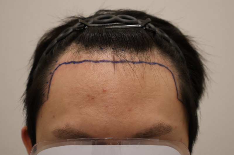 ドンタンヘアで植毛医院2000本 2週目の経過後の体験談