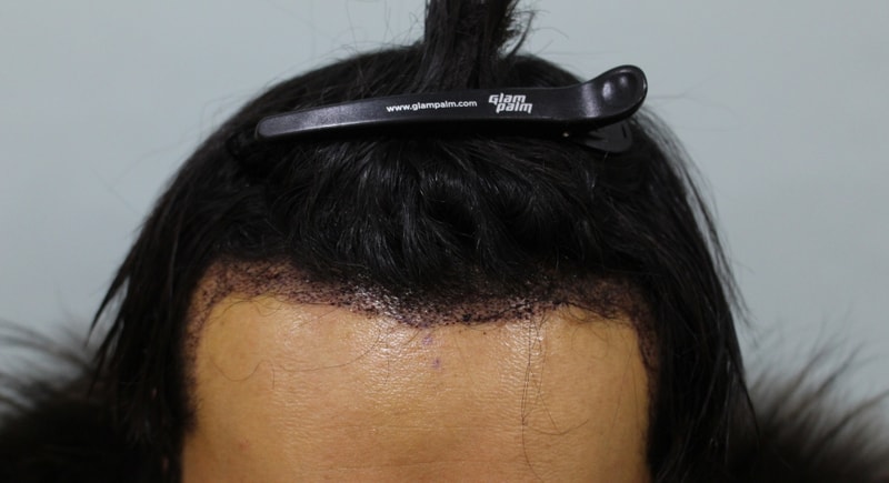 수술후3일 (3).JPG
