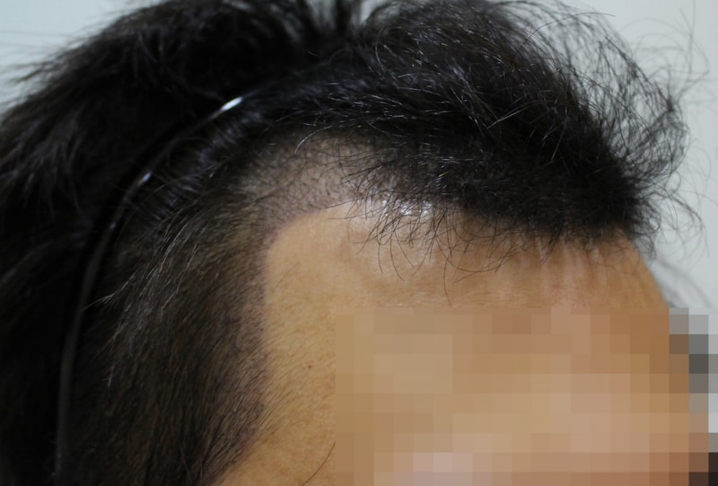 수술 후 10일차.jpg
