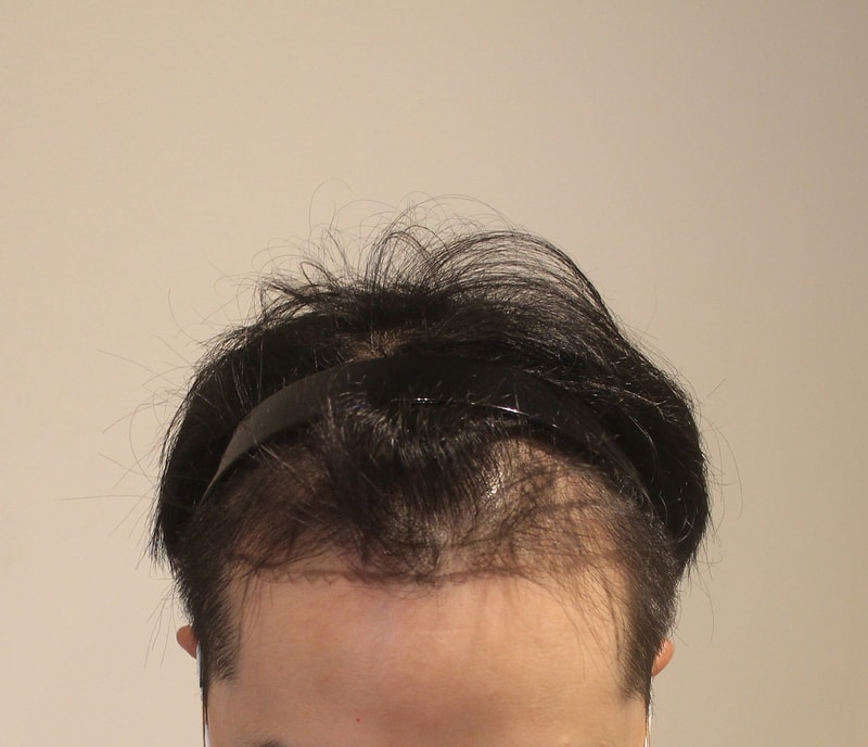 뉴헤어 비절개모발이식 1600모낭 6일차 후기