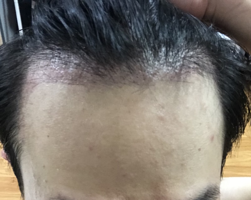 모발이식 3300모 1개월차 포토리뷰