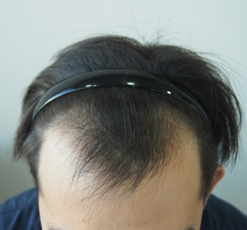 수술전 정면.JPG