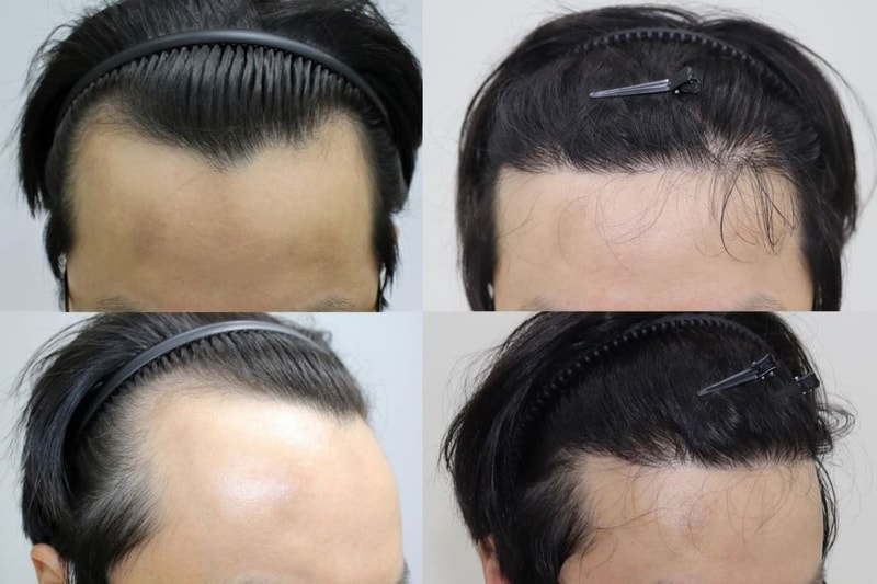 포헤어 비절개무삭발 8개월 머리결도 좋고 디자인도 맘에 드네요