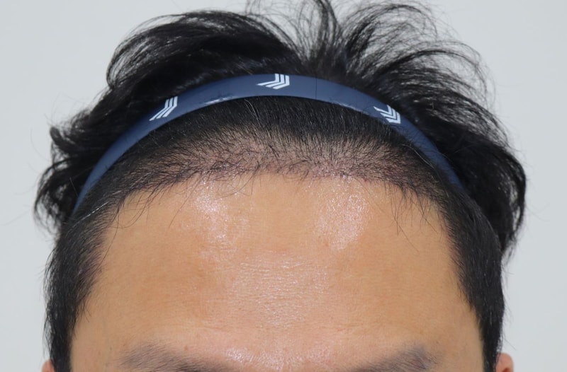 02.4개월경과.JPG