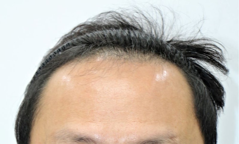 서울 포헤어 4000모 대량이식 후 4개월입니다