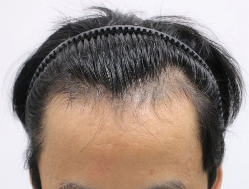 압구정 포헤어  정대건원장님 M자탈모 비절개 4달차