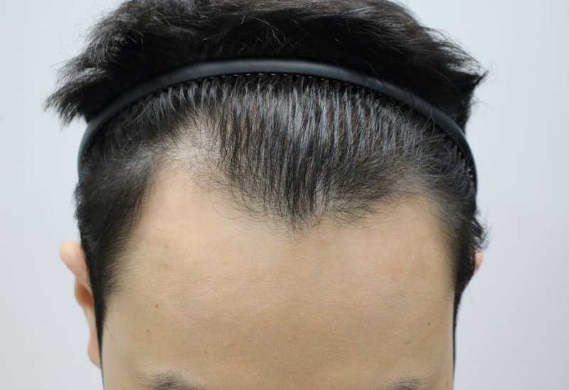 포헤어 비대칭M자 비절개무삭발 7개월 후기