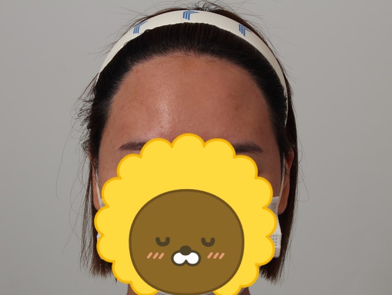 01.헤어라인 10달.jpg