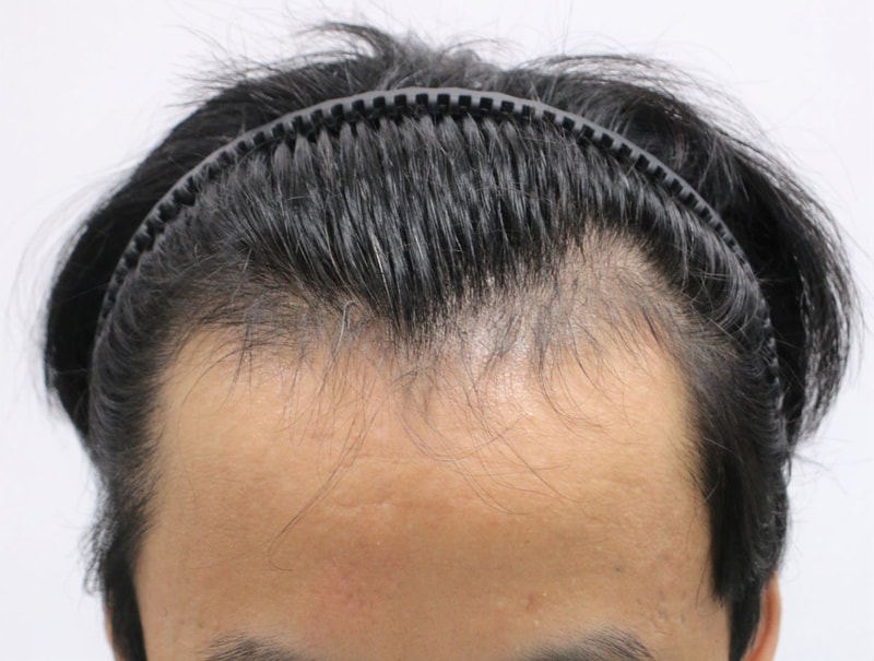 압구정 포헤어 정대건 원장님_ M자탈모 비절개 1달차