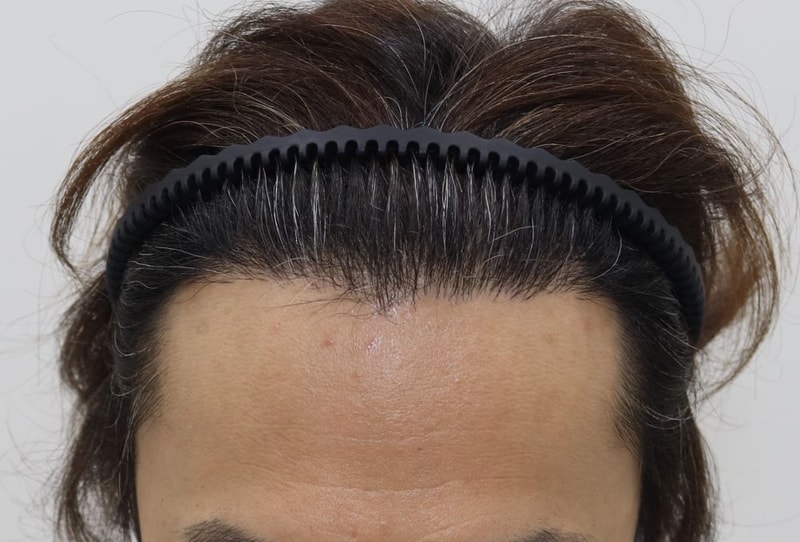 10.M자수술후.JPG
